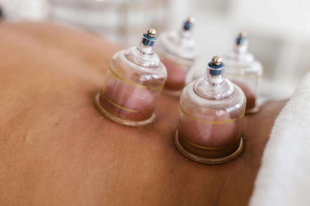 Cupping therapy cups placed on a person's back, showing skin with minimal redness.